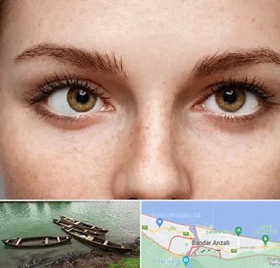 متخصص انحراف چشم در بندر انزلی