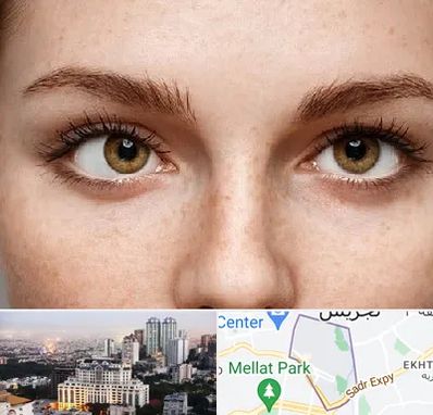 متخصص انحراف چشم در الهیه 