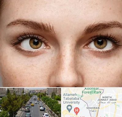 متخصص انحراف چشم در شهران 