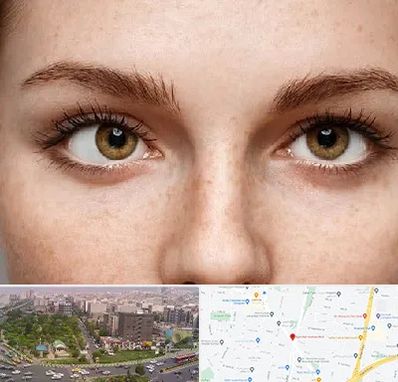 متخصص انحراف چشم در آیت الله کاشانی