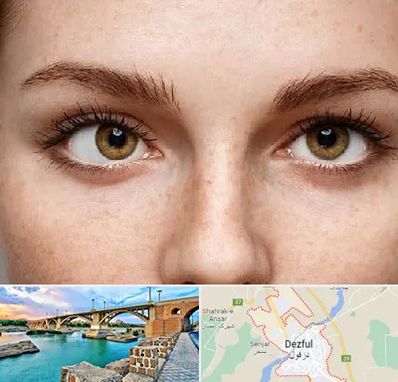 متخصص انحراف چشم در دزفول