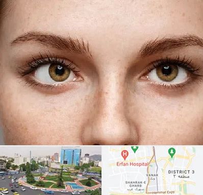 متخصص انحراف چشم در ونک 