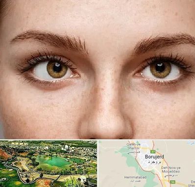 متخصص انحراف چشم در بروجرد