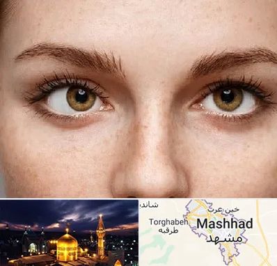 متخصص انحراف چشم در مشهد