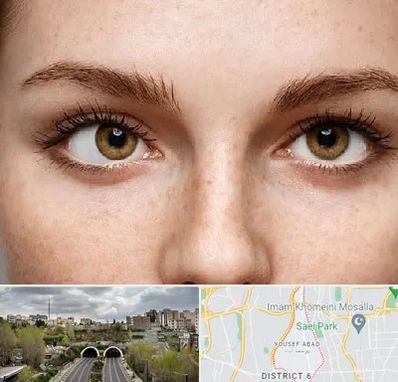 متخصص انحراف چشم در یوسف آباد 