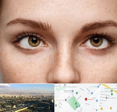 متخصص انحراف چشم در هنگام 