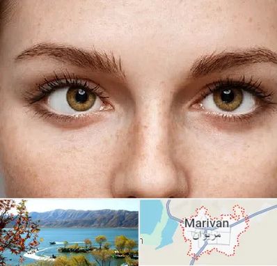 متخصص انحراف چشم در مریوان