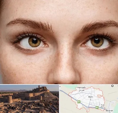 متخصص انحراف چشم در بم
