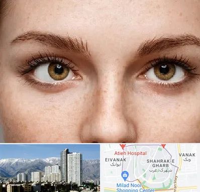 متخصص انحراف چشم در شهرک غرب 
