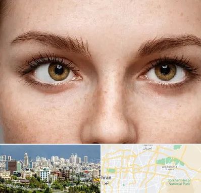 متخصص انحراف چشم در شرق تهران 