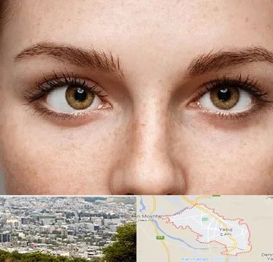 متخصص انحراف چشم در یاسوج