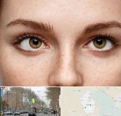 متخصص انحراف چشم در نظرآباد کرج 