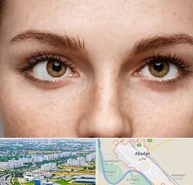 متخصص انحراف چشم در آبادان