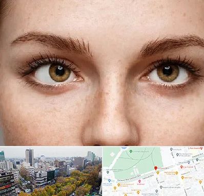 متخصص انحراف چشم در بلوار کشاورز 