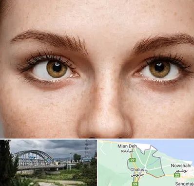 متخصص انحراف چشم در چالوس