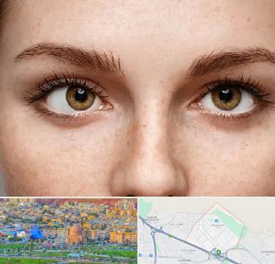 متخصص انحراف چشم در رشدیه تبریز