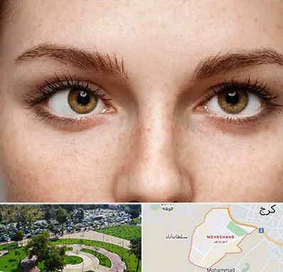 متخصص انحراف چشم در مهرشهر کرج 