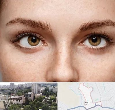 متخصص انحراف چشم در اوین