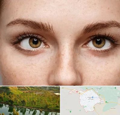 متخصص انحراف چشم در بهبهان