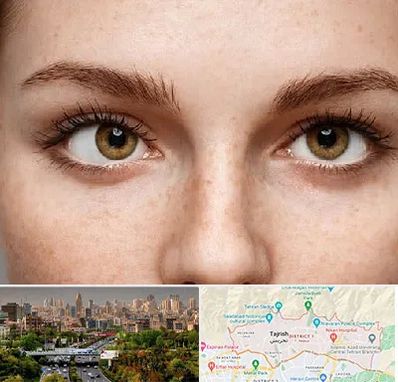 متخصص انحراف چشم در منطقه 1 تهران 