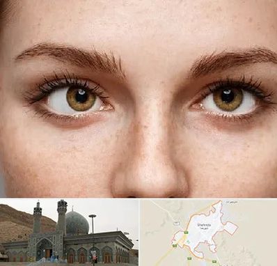 متخصص انحراف چشم در شهرضا