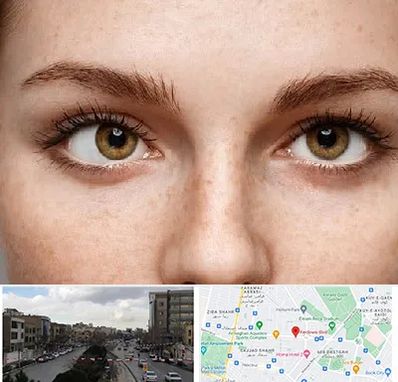 متخصص انحراف چشم در بلوار فردوسی مشهد 