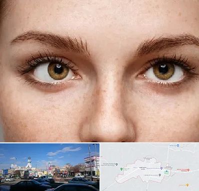 متخصص انحراف چشم در ماهدشت کرج 