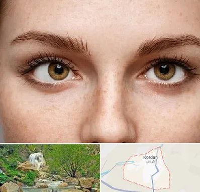 متخصص انحراف چشم در کردان