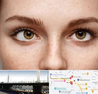 متخصص انحراف چشم در پارک وی 