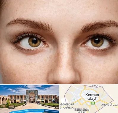 متخصص انحراف چشم در کرمان