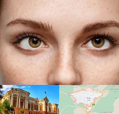 متخصص انحراف چشم در خوی