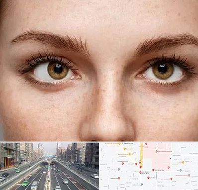 متخصص انحراف چشم در توحید 