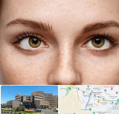 متخصص انحراف چشم در صیاد شیرازی مشهد