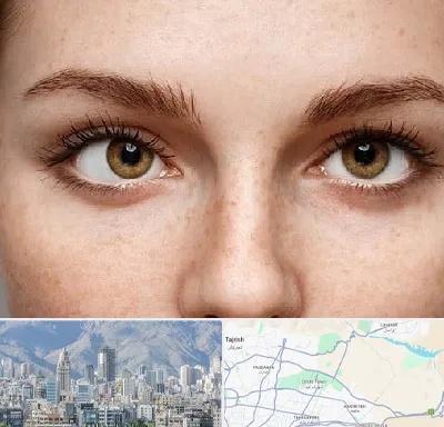 متخصص انحراف چشم در شمال شرق تهران