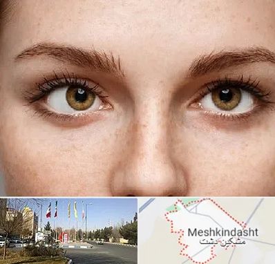 متخصص انحراف چشم در مشکین دشت