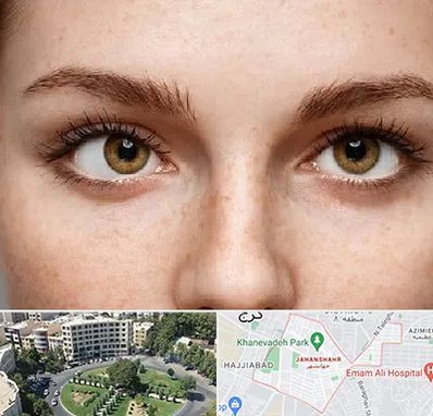 متخصص انحراف چشم در جهانشهر کرج 