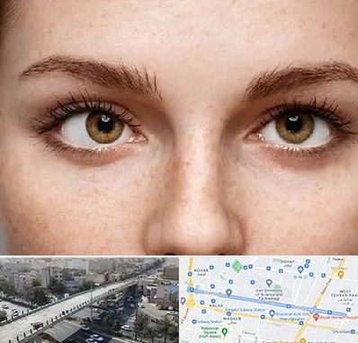 متخصص انحراف چشم در فرجام