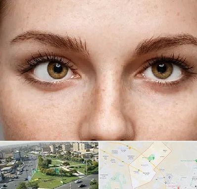 متخصص انحراف چشم در کمال شهر کرج 