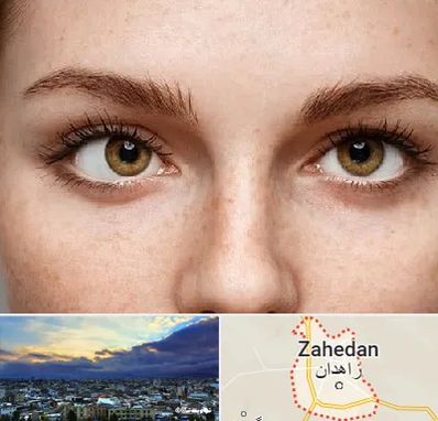 متخصص انحراف چشم در زاهدان