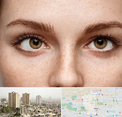 متخصص انحراف چشم در منطقه 5 تهران 