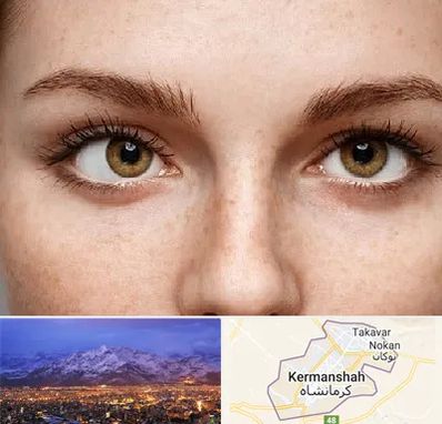 متخصص انحراف چشم در کرمانشاه