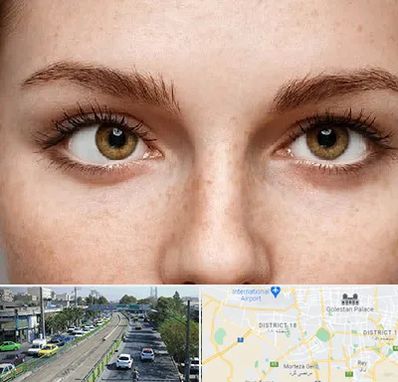 متخصص انحراف چشم در جنوب تهران 