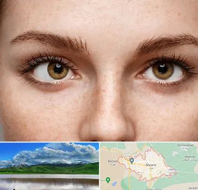 متخصص انحراف چشم در مرند