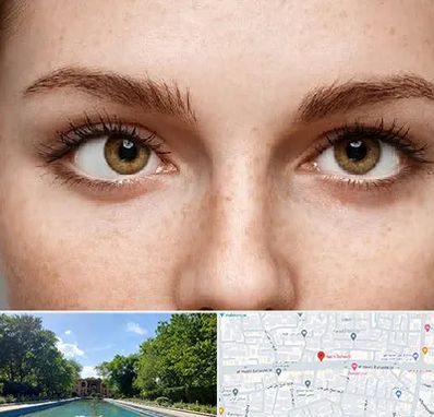 متخصص انحراف چشم در هشت بهشت اصفهان