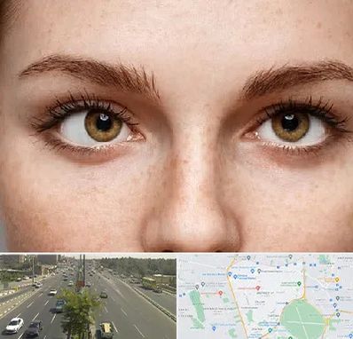 متخصص انحراف چشم در منطقه 17 تهران 