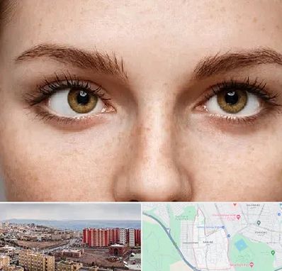 متخصص انحراف چشم در سهند تبریز