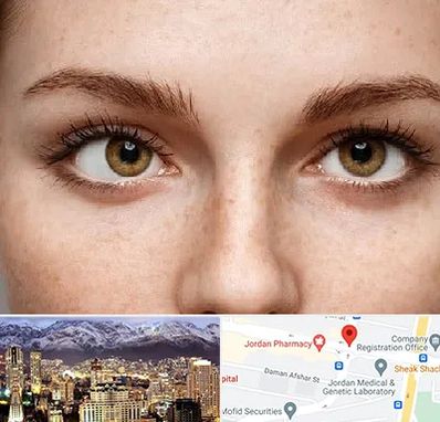 متخصص انحراف چشم در جردن 