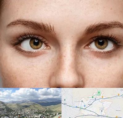 متخصص انحراف چشم در رودهن