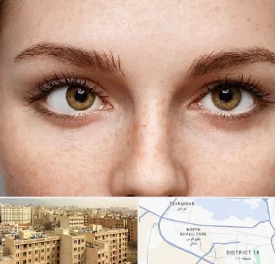 متخصص انحراف چشم در جنوب غرب تهران