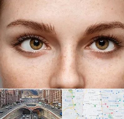 متخصص انحراف چشم در منطقه 10 تهران 